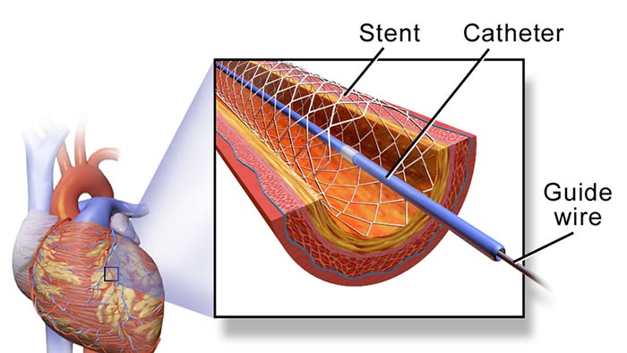 Cross section diagram depicting a stent in a coronary artery